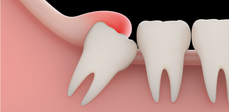 Flap of Gums Over Wisdom Tooth: A Comprehensive Guide