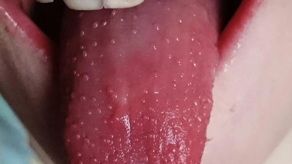Red Dots on Tongue: The Causes and How to Treat Them