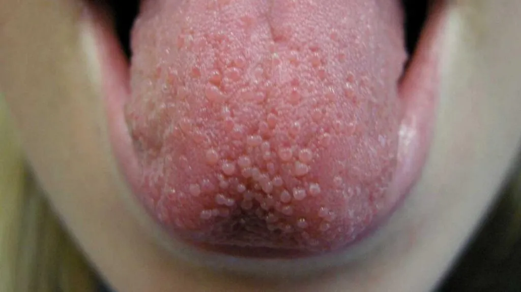 What to Do for a Pimple Under the Tongue: Causes and Treatment
