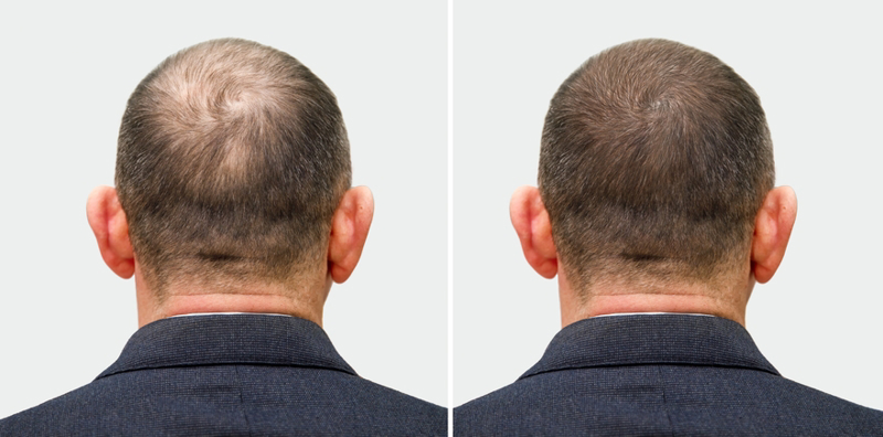 How Much Does Hair Transplant Cost In Nyc