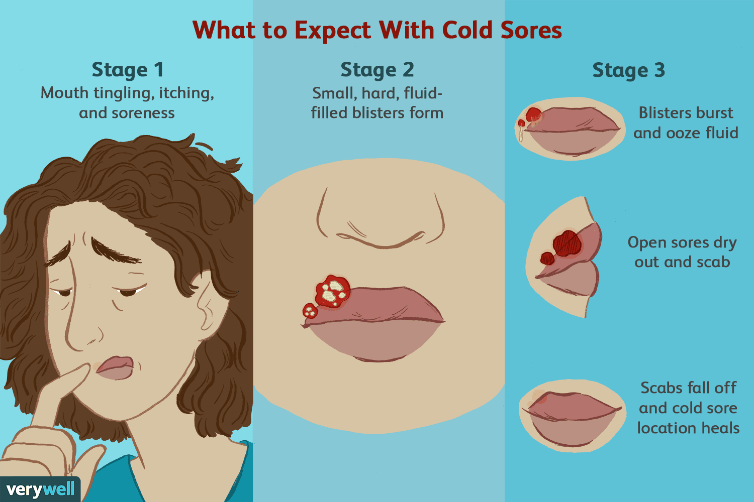 Get Rid of Cold Sores Fast: Effective Strategies for Quick Relief