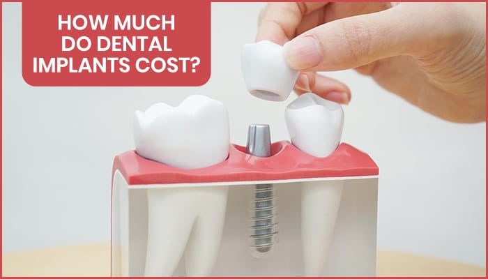 How Much Do Dental Implants Cost In New Jersey